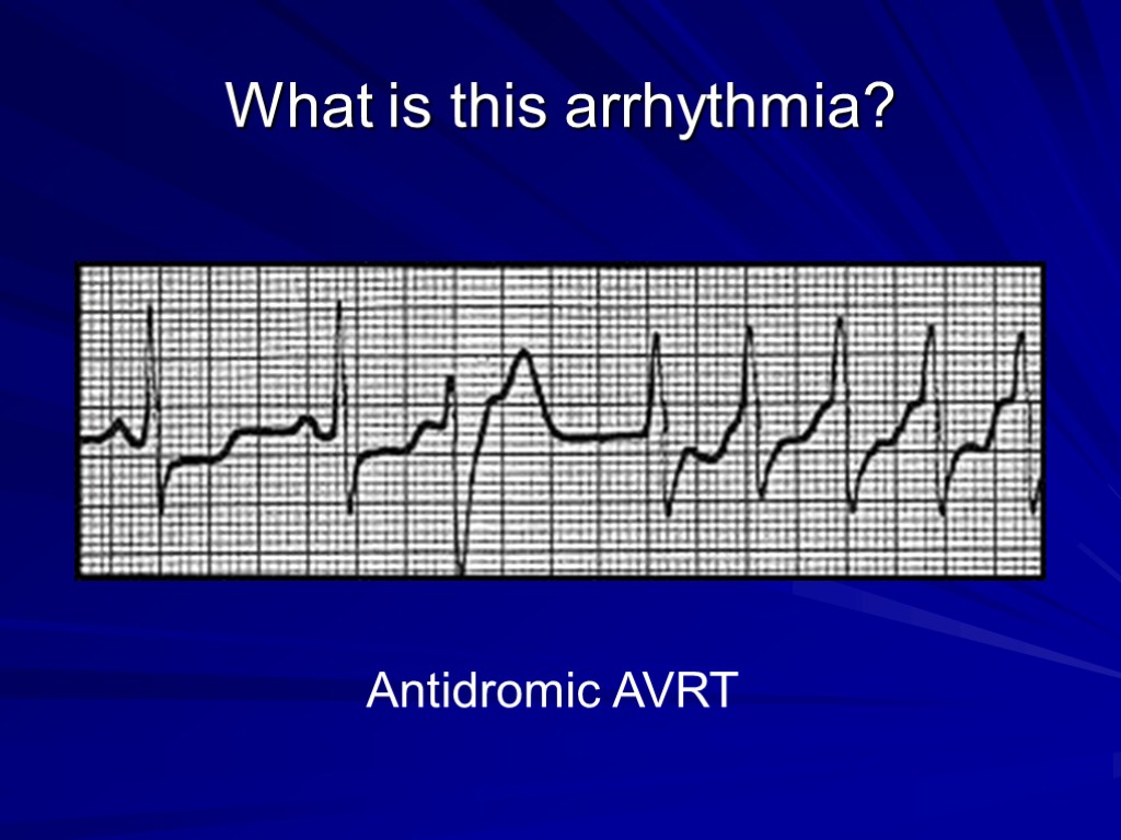 What is this arrhythmia? Antidromic AVRT